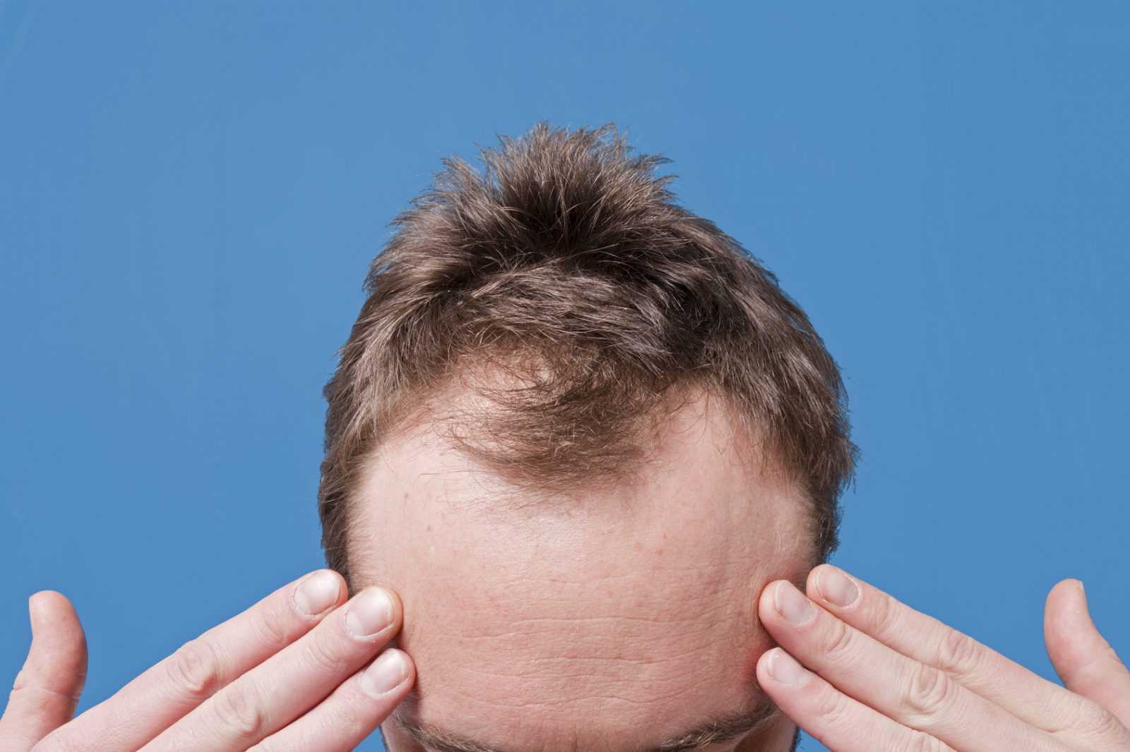 Выпадение волос: причины и лечение у мужчин
